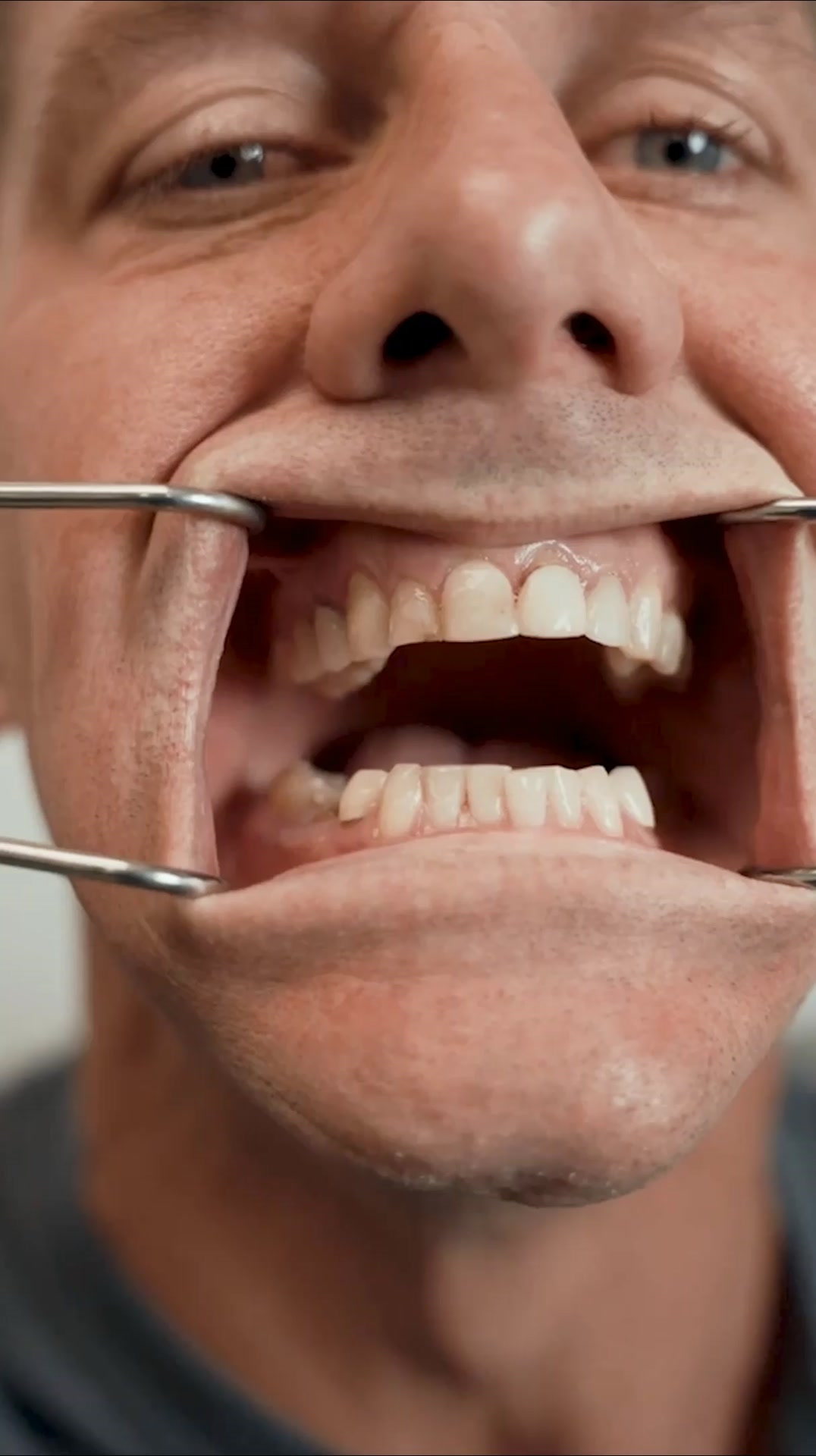 New Permanent Teeth Are Just 24 Hours Away!