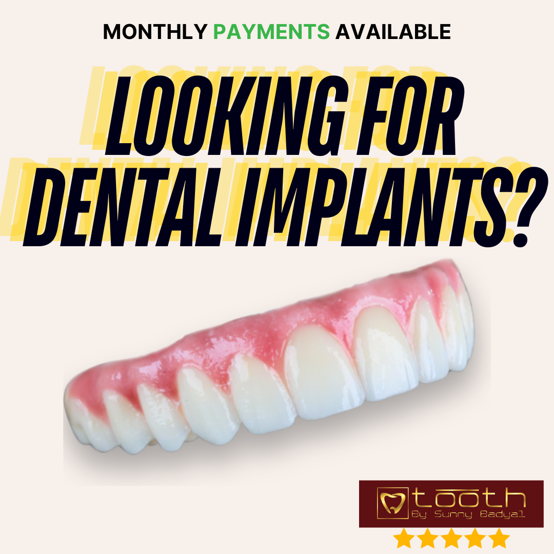 Get Implant Teeth In 1 DAY ✅