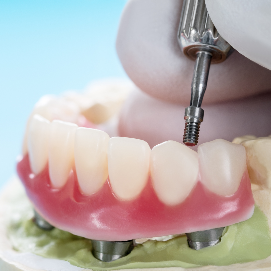 Limited to 50 Patients: Snap in Denture Discount Program!😍