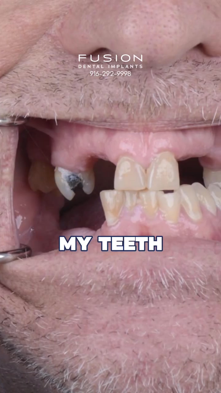 Dental Implants Club El Dorado Hills Implant Dentist ad creative