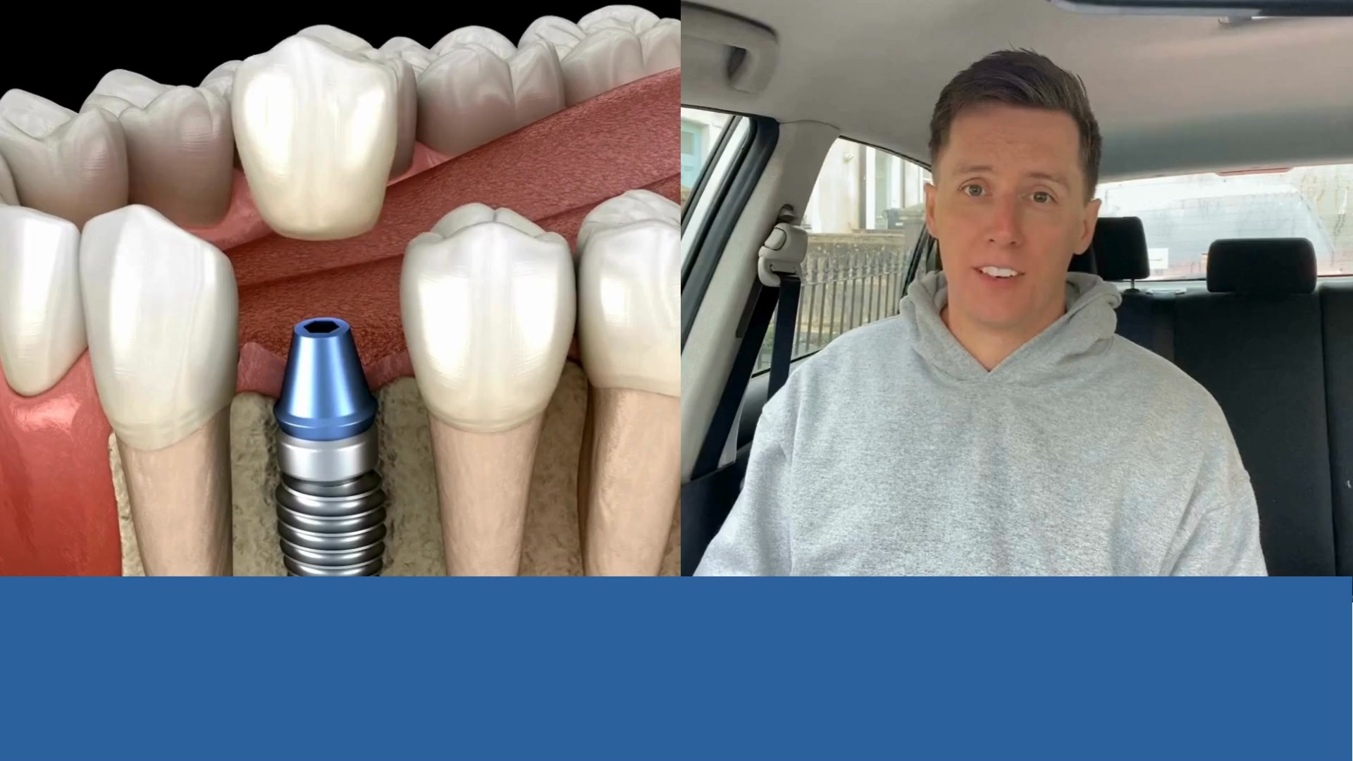 🔥🔥 Take Our Eligibility Quiz Below. ✨ Dental Implants are just like natural teeth. 🦷