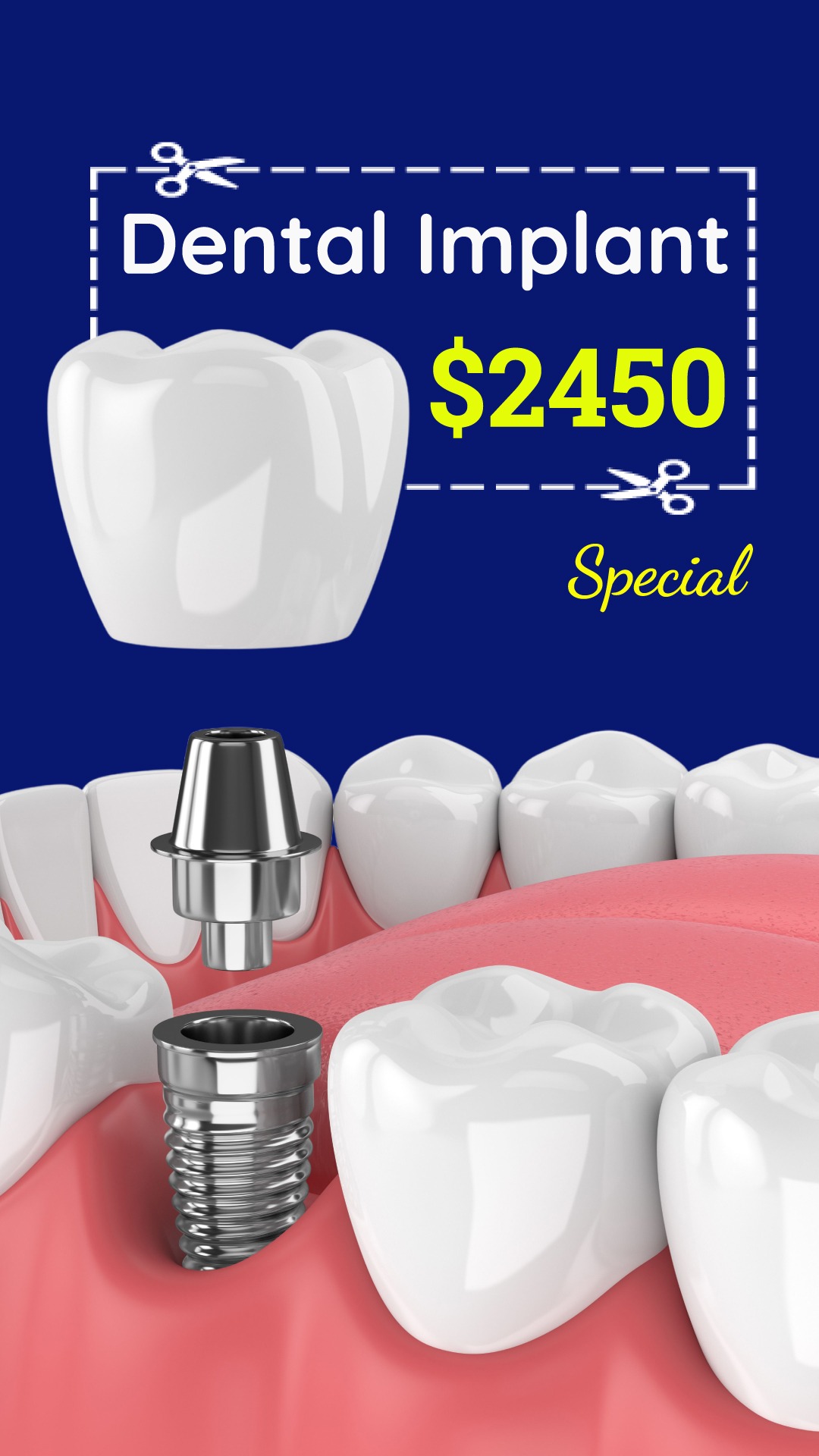 $2450 Dental Implant