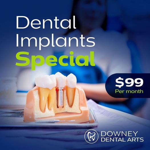 Dental Implants Single Tooth Replacement $99 to Start!