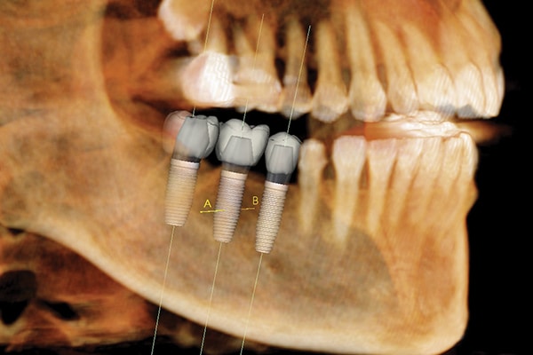 Full Mouth Implants – Now Affordable, Achieve Your Dream Smile