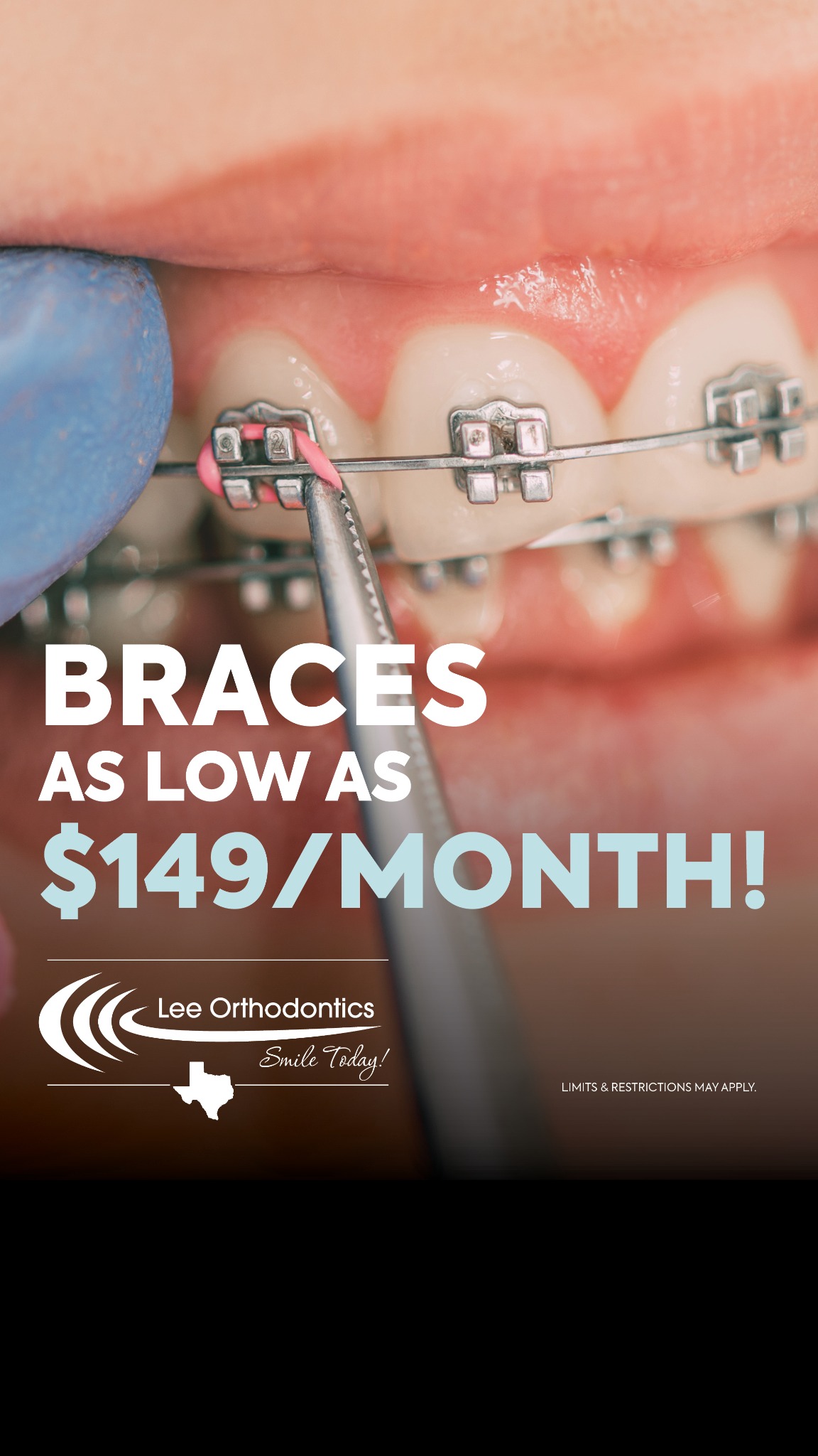 Braces As Low As $149/Month 🙌