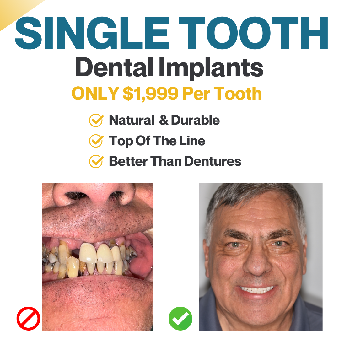 Custom Single Tooth Implants ONLY $1,999 Per Tooth