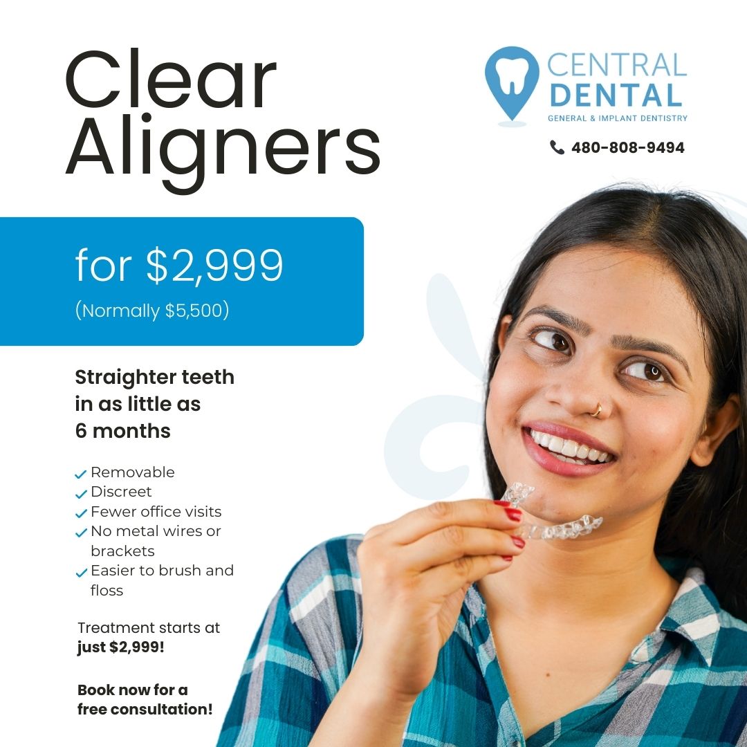 Clear Aligners in Phoenix