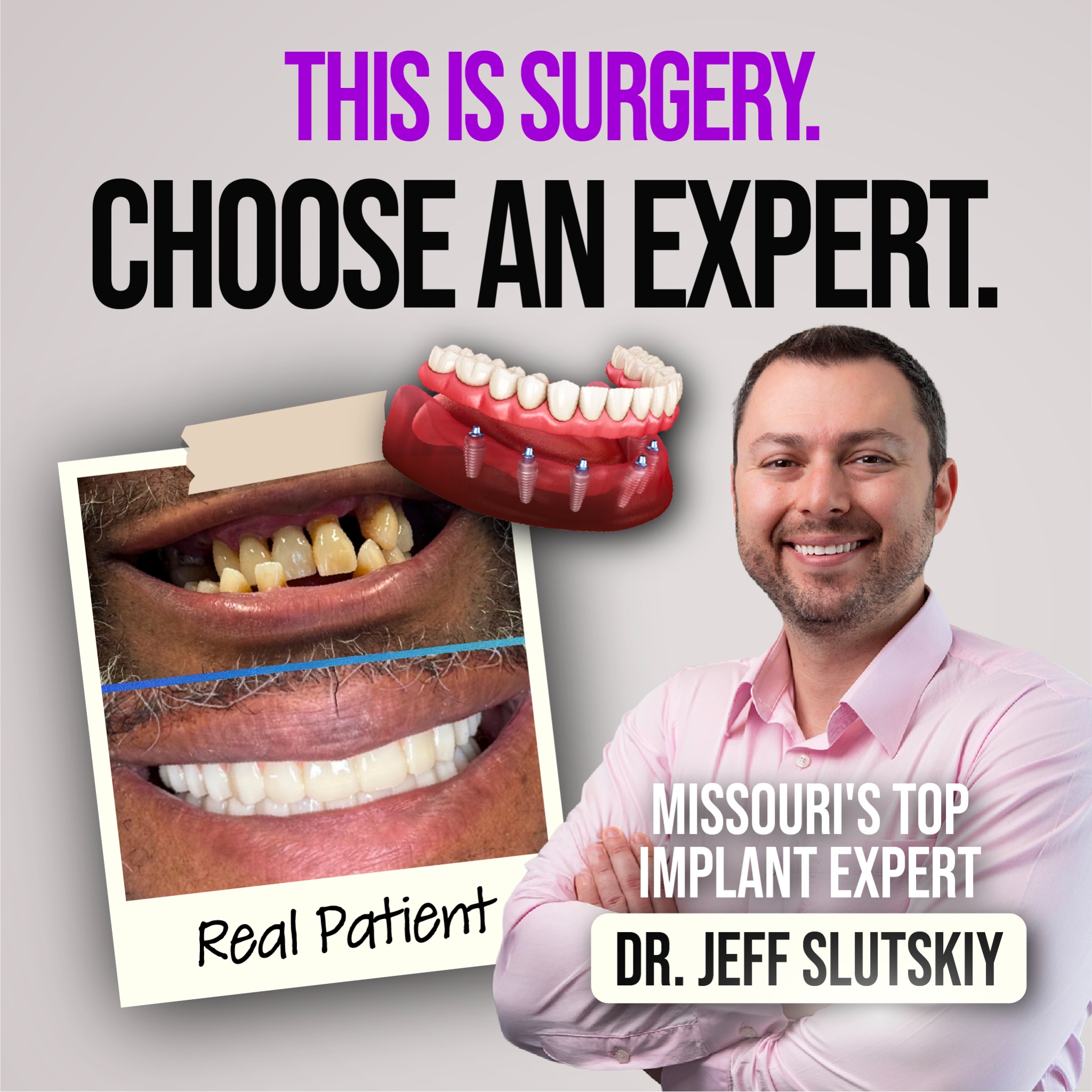 $700–$6,000 Off Dental Implants In Odessa