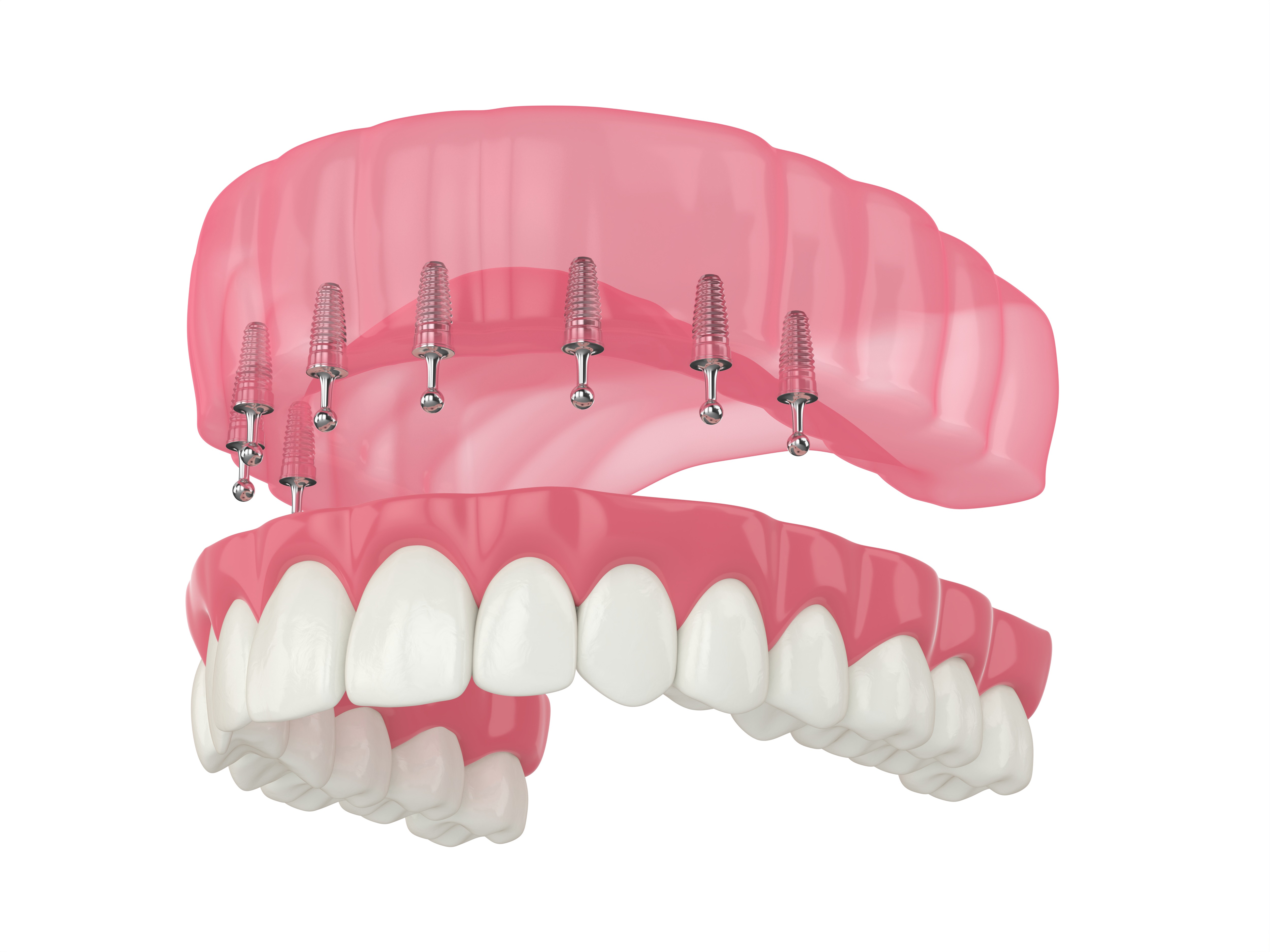 Limited to 50 Patients: Snap in Denture Discount Program!😍