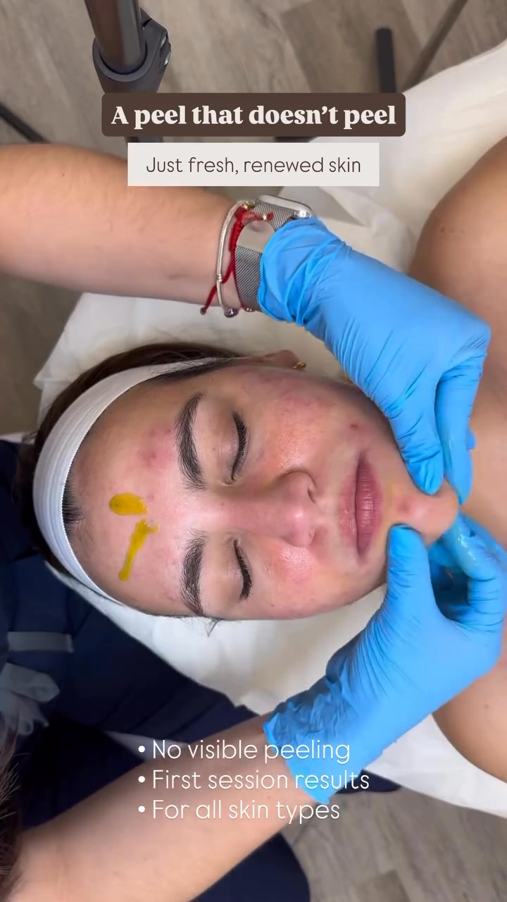 The No-Peel Peel That Transforms Your Skin