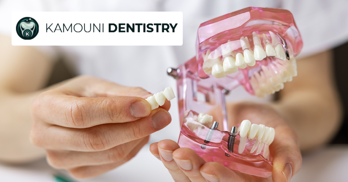 Dental Implant and Crown ONLY $1,999!