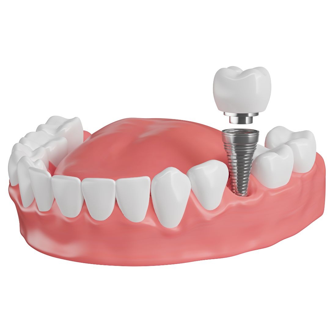 Apex Dental Implant Dentist ad creative