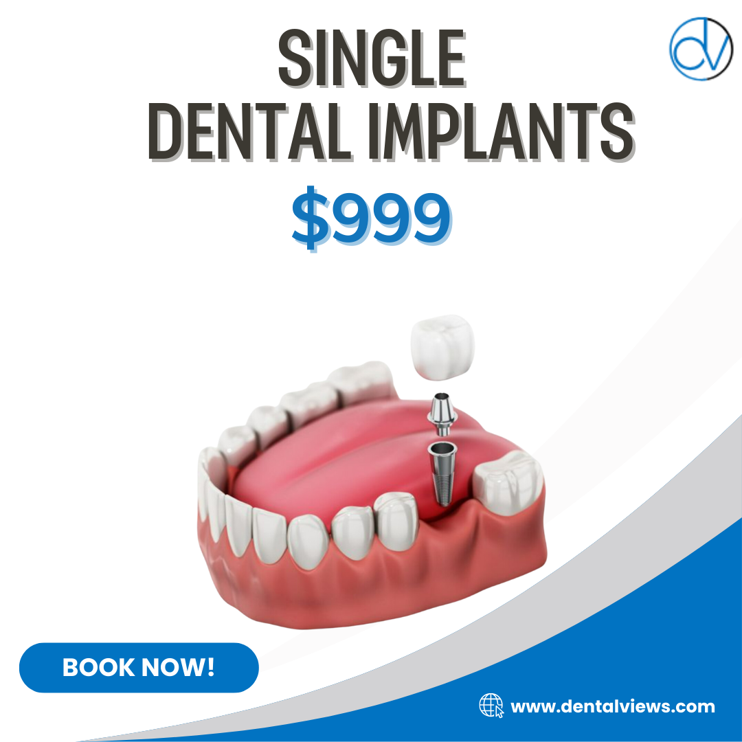 👉Single Dental Implants As Low As $999