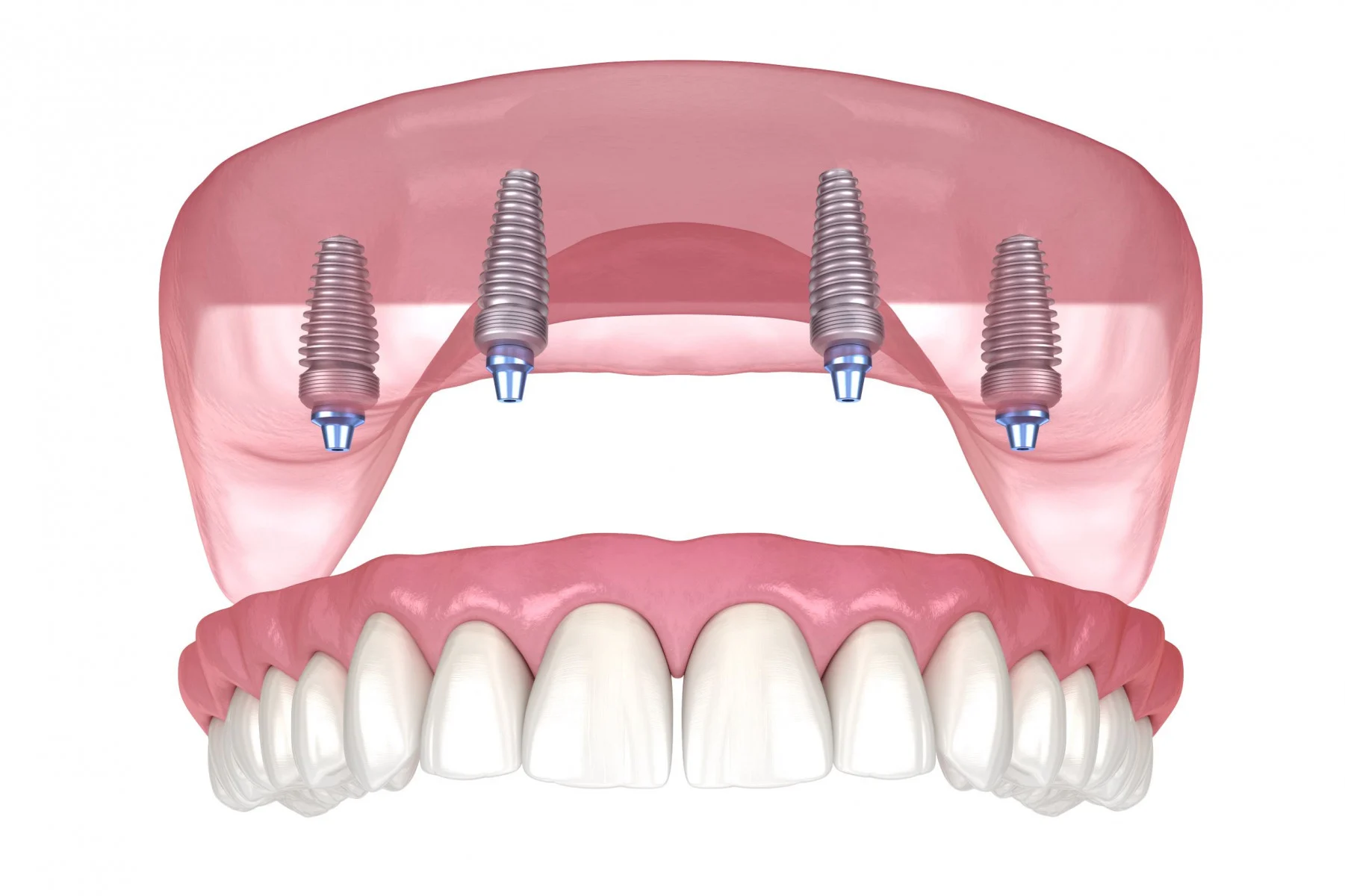 $213/Month All Inclusive Full Mouth Implants