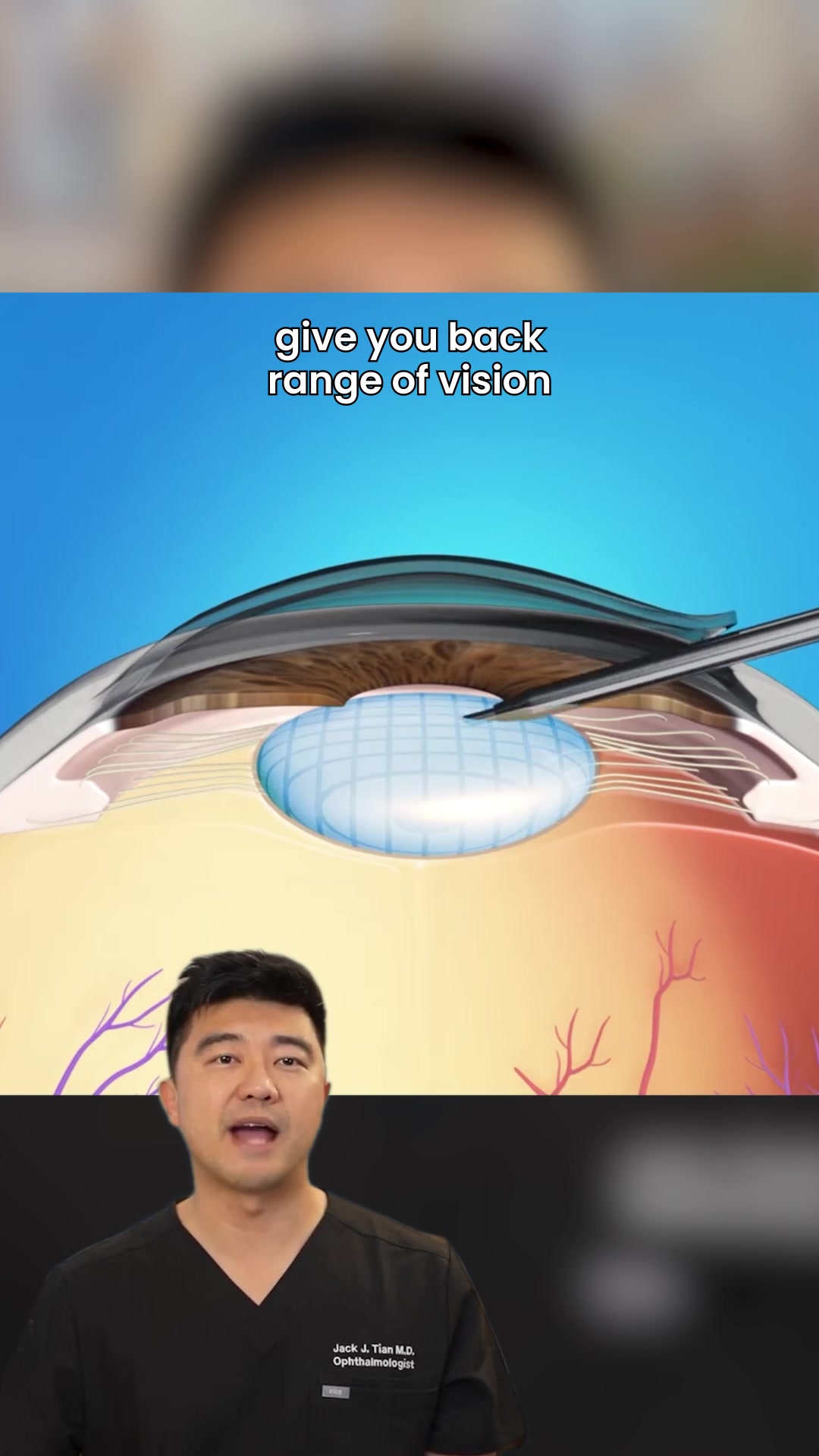 Refractive Lens Exchange