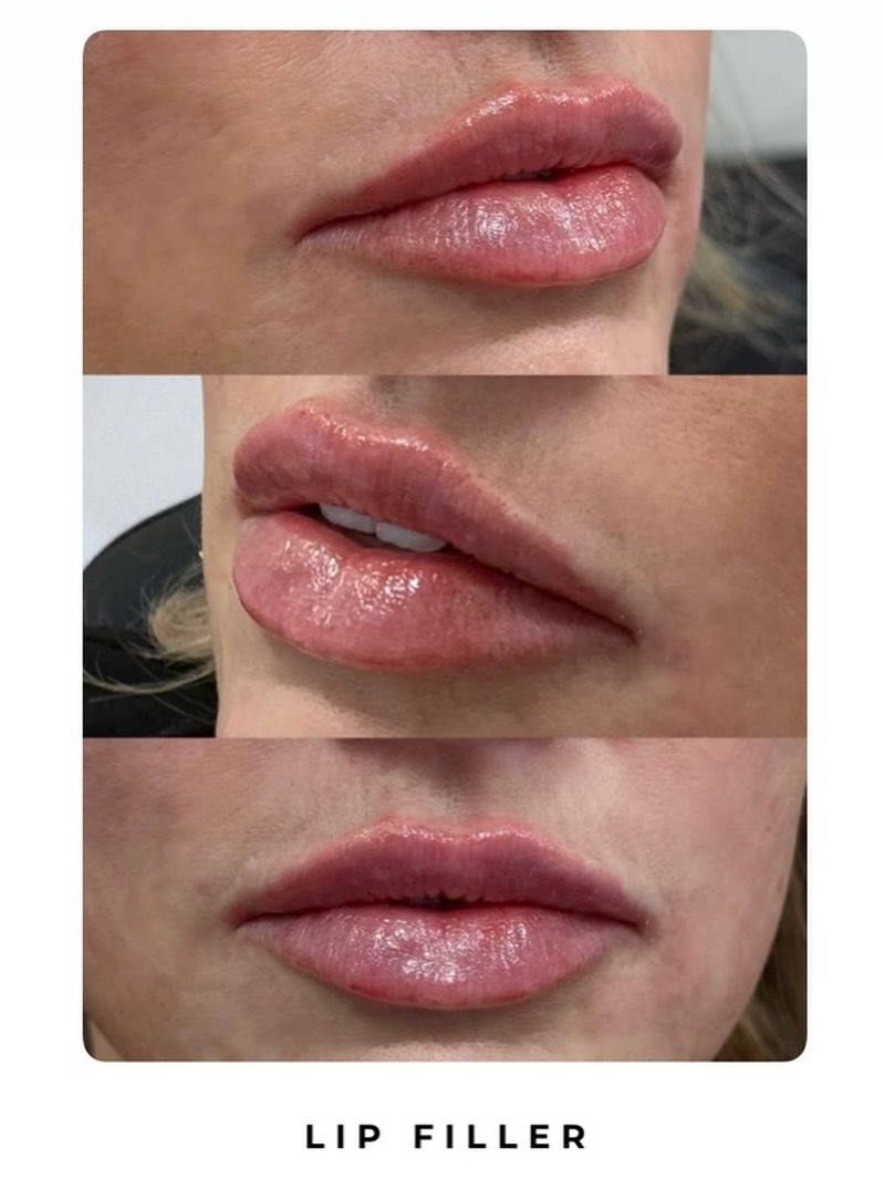 Holli Tindall - RN • Woodlands Nurse Injector Med Spa ad creative