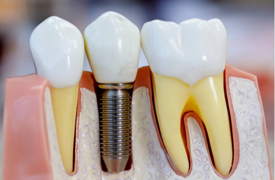 Dental Implants - Restorative Dentistry - Healdsburg Dental Spa