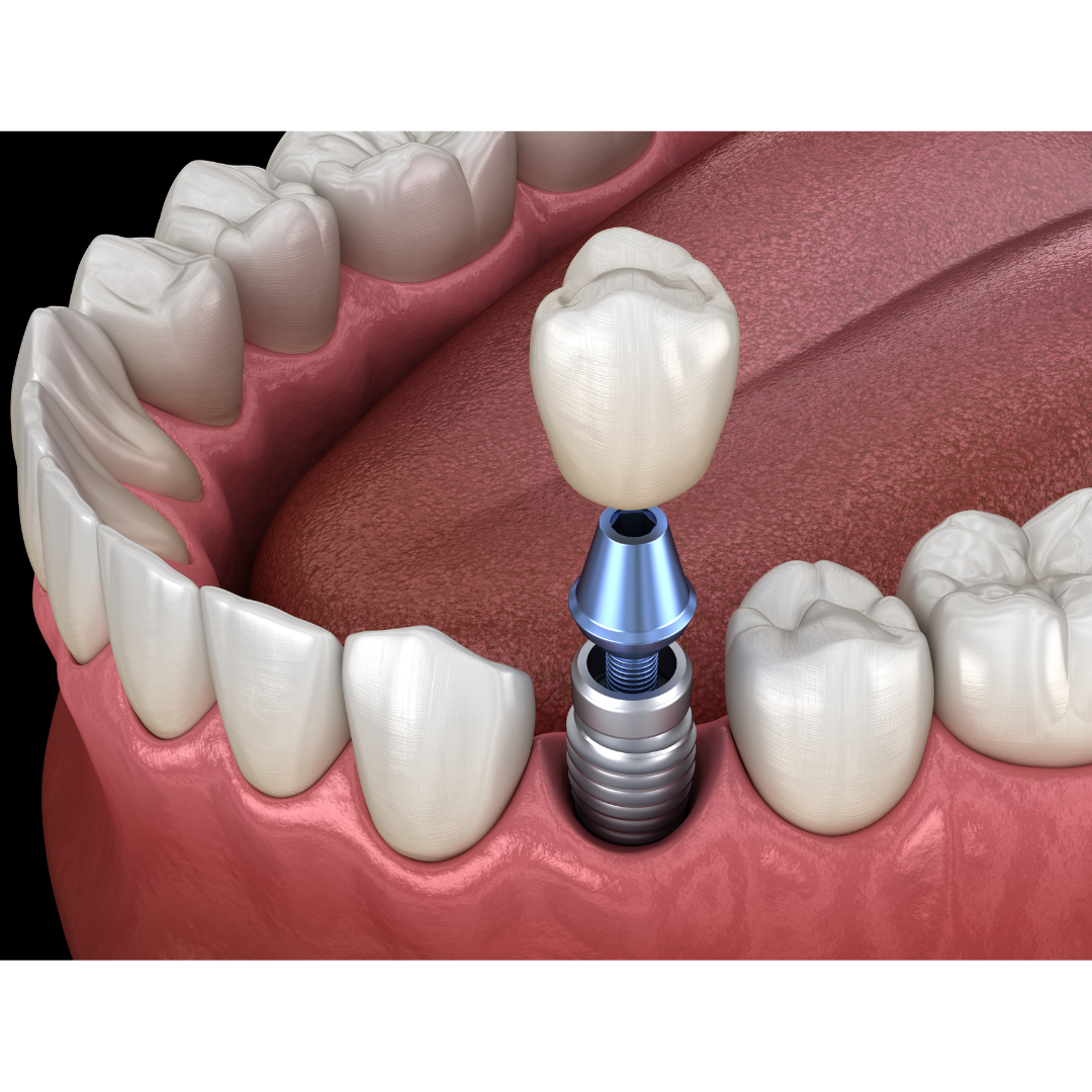 Mid-Columbia Dental Implant Dentist ad creative