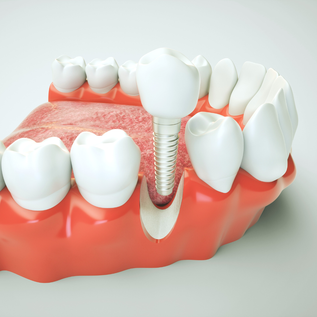 Renken Dentistry of Oak Hill Implant Dentist ad creative