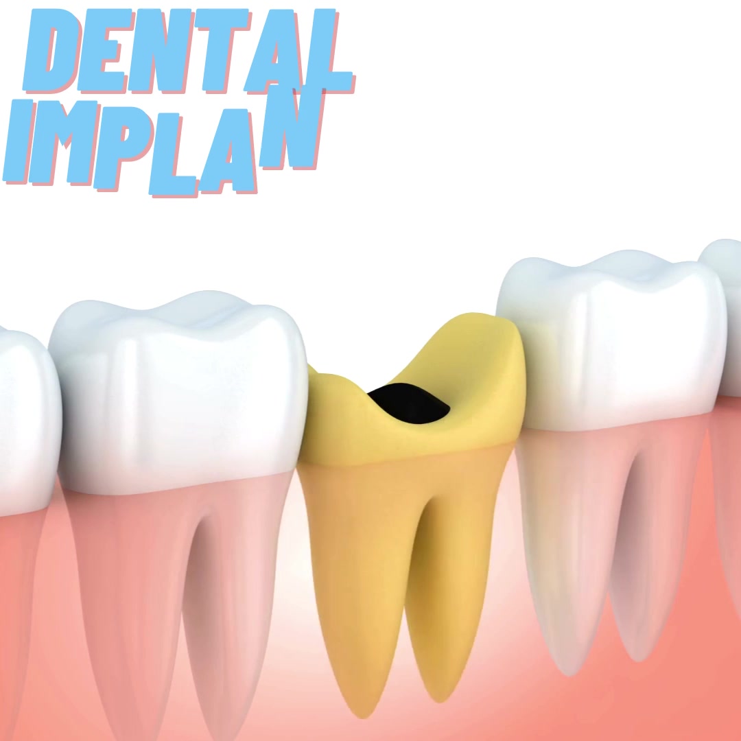 Free X-rays & Dental Implant Consultation