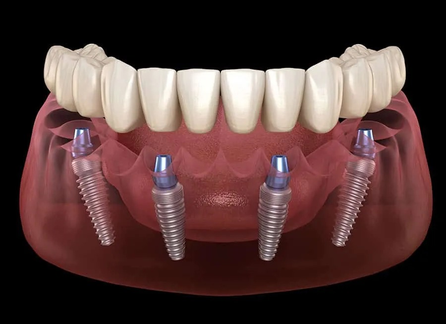 $213/Month Full Mouth Implants - All Inclusive