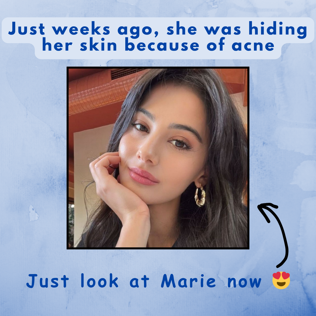 AviClear® Acne Treatment (Houston, TX)