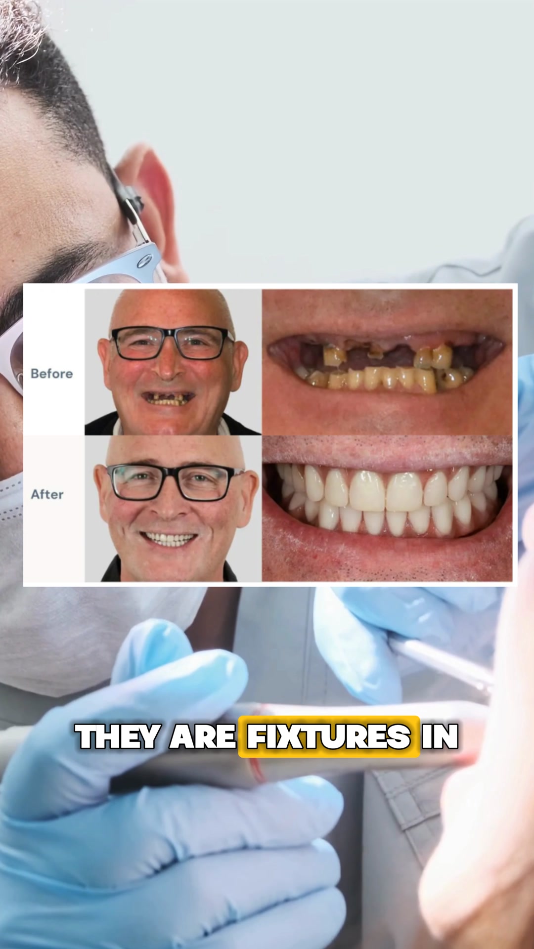 Dentures vs. Implants?