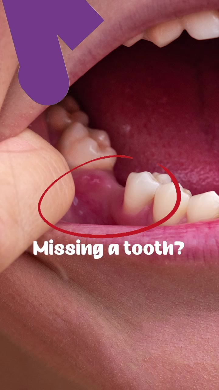 Save $2100 on Implants 🤩