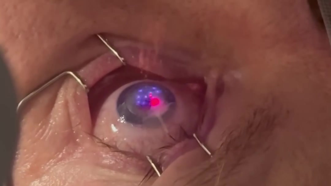 Some of Denver’s Most Experienced LASIK Surgeons