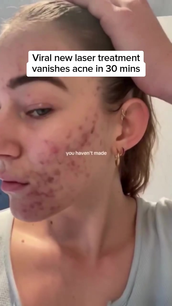 AviClear® Acne Treatment (Houston, TX)