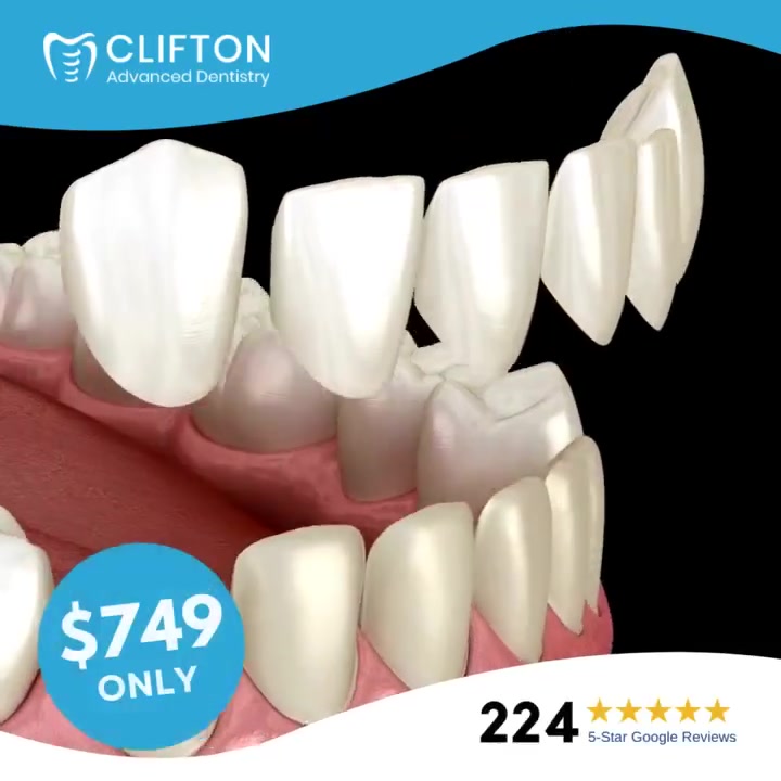 $749 Porcelain Veneers to Repair Damaged Teeth! ($749 Each)
